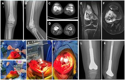 Custom-made semi-joint prosthesis replacement combined ligament advanced reinforcement system (LARS) ligament reconstruction for the limb salvage surgery of malignant tumors in the distal femur in skeletal immature children